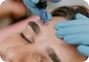Man receiving microneedling treatment